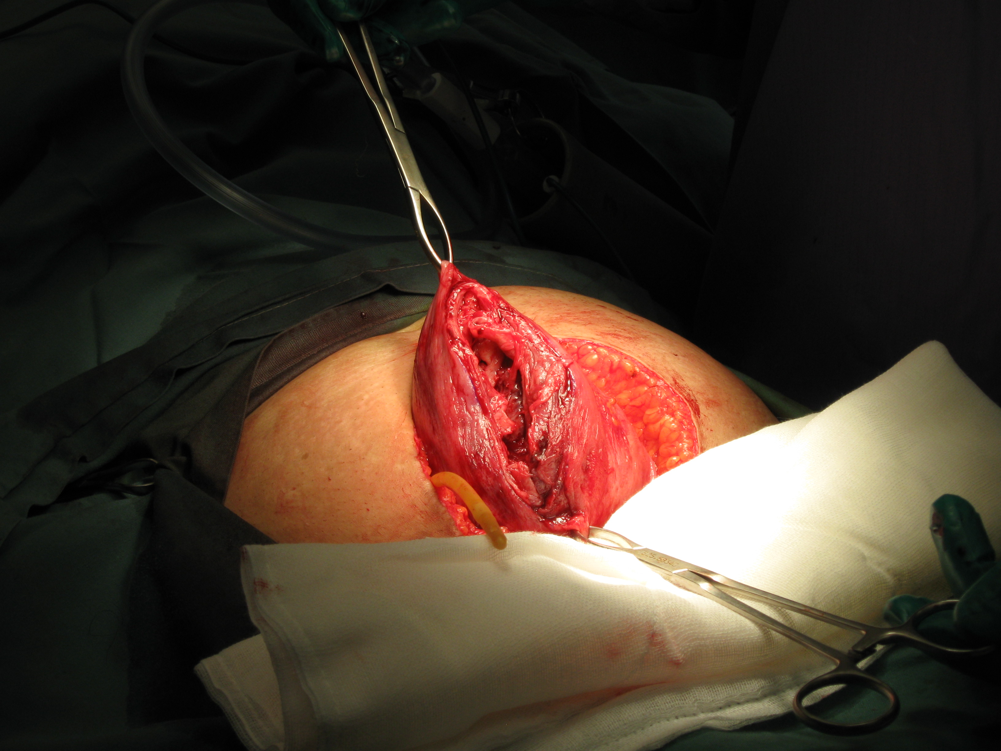 Fibroid Abdominal Myomectomy Serag Youssif (13)